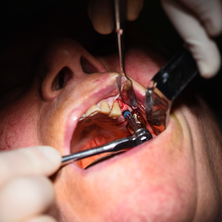 implantology